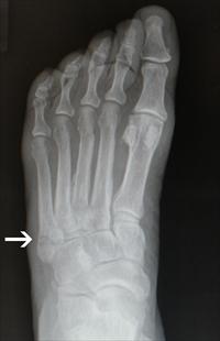An X-ray, in shades of grey and black, of a left foot with a tiny fracture on the far left side, near where the foot meets the ankle.