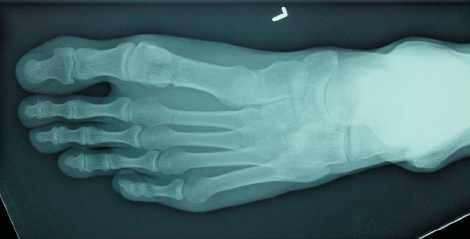 An X-ray, in shades of blue and green, of a healthy left foot.